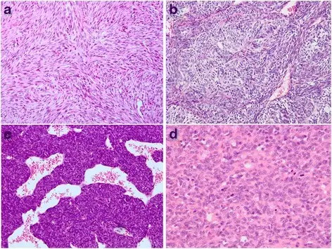 Synovial Sarcoma