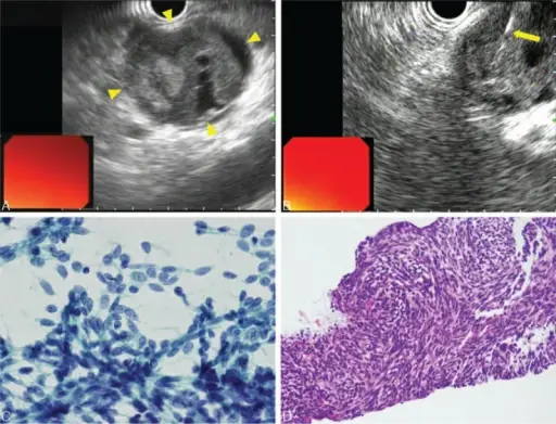 Synovial Sarcoma