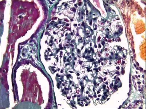 Systemic Diseases Associated with Glomerular Lesions