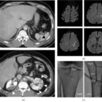 Systemic Embolism