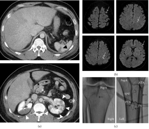 Systemic Embolism