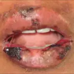 Systemic Lupus Erythematosus