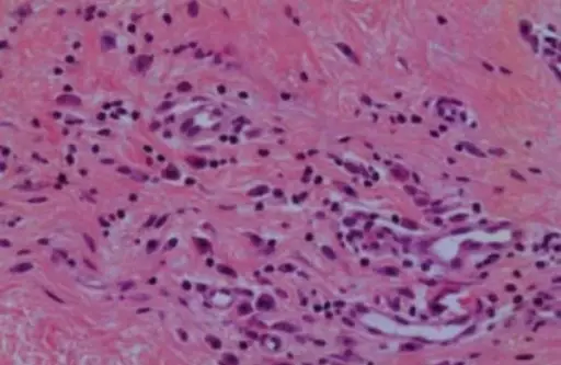 Systemic Mastocytosis