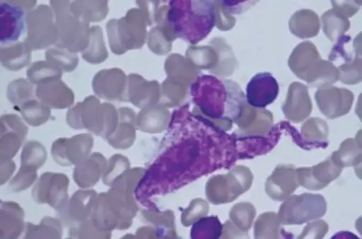 Systemic Mastocytosis