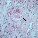 T Cell-mediated reactions in Transplant Rejection