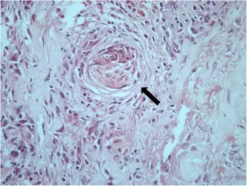 T Cell-mediated reactions in Transplant Rejection