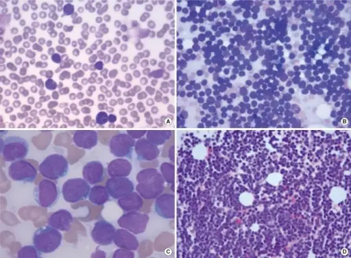 T-cell Acute Lymphoblastic Leukemia/Lymphoma (T-ALL)