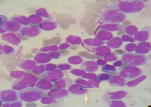 T-cell Acute Lymphoblastic Leukemia