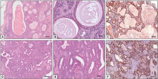 THE BENIGN SALIVARY GLAND TUMORS