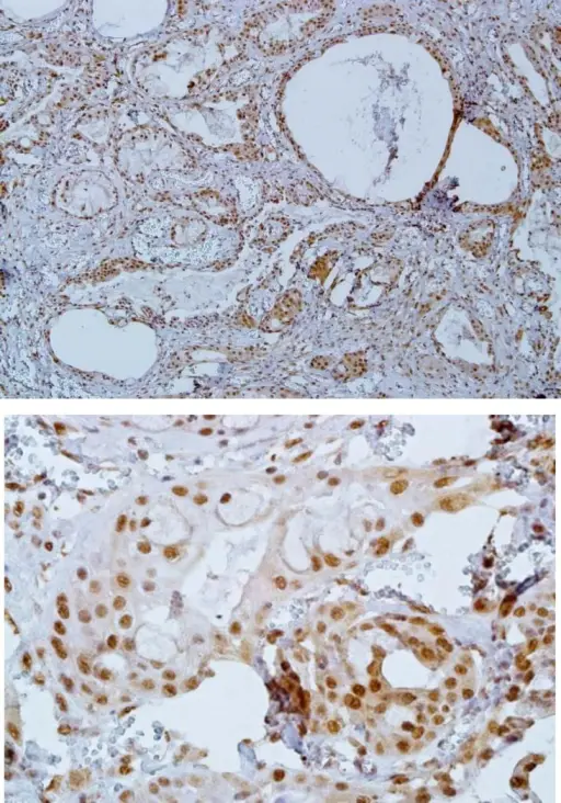 THE MALIGNANT SALIVARY GLAND TUMORS