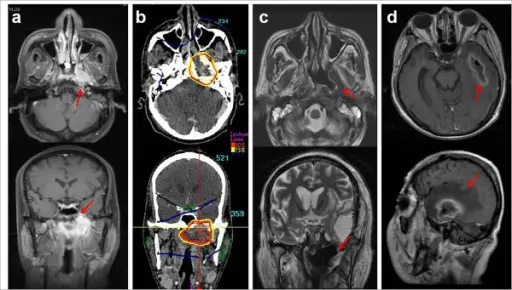 THE PATTERNS OF TISSUE NECROSIS