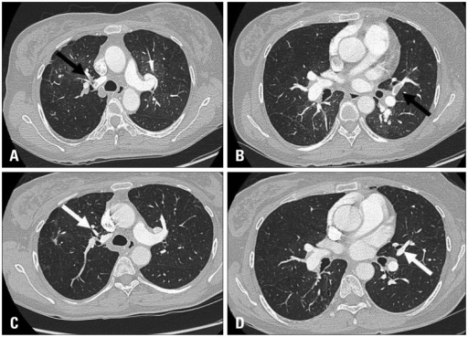 THROMBOEMBOLIC DISEASE