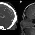 THROMBOSIS