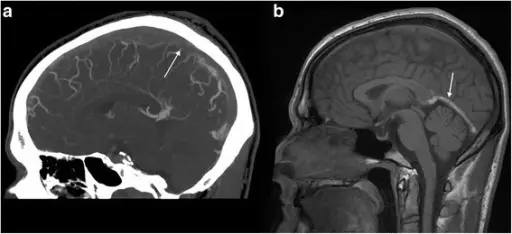 THROMBOSIS