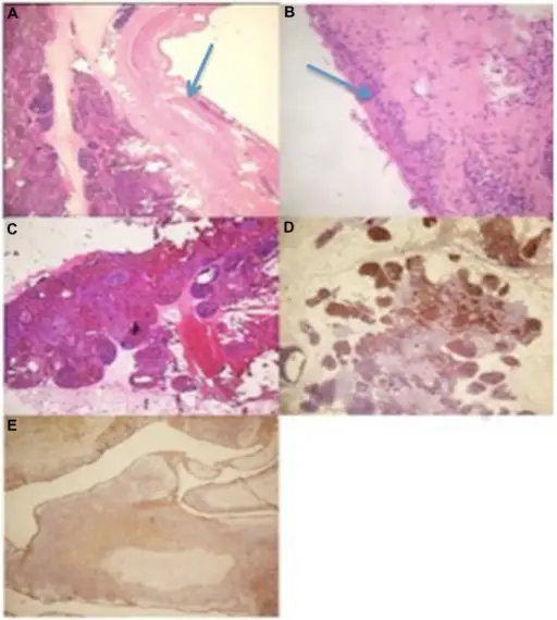 THYMIC HYPERPLASIA