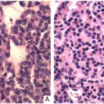 THYROID GLAND PATHOLOGY