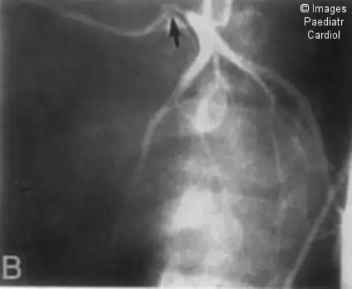 Takayasu Arteritis