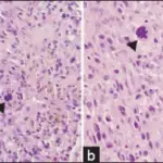 Tenosynovial Giant Cell Tumor