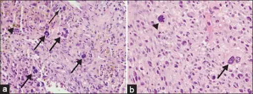 Tenosynovial Giant Cell Tumor