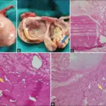 Teratomas of the Ovary