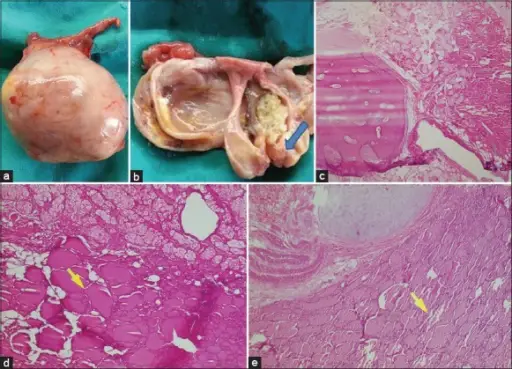 Teratomas of the Ovary