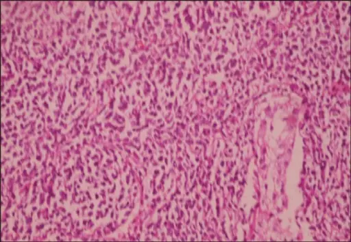 Testicular Lymphoma