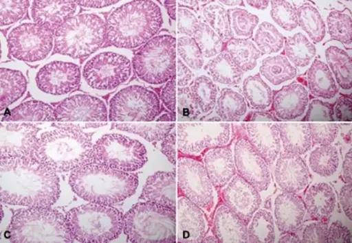 Testicular Torsion