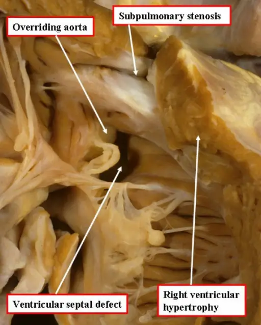 Tetralogy of Fallot