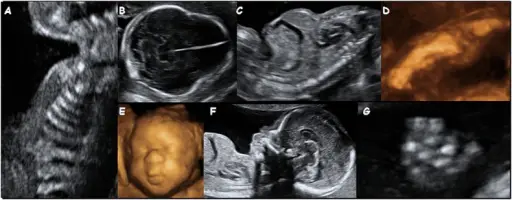 Thanatophoric Dysplasia