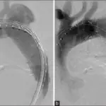 Thoracic Aortic Aneurysm