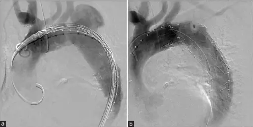 Thoracic Aortic Aneurysm