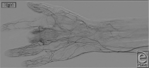 Thromboangiitis Obliterans (Buerger's Disease).