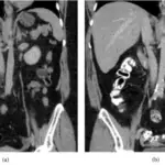 Thrombophlebitis