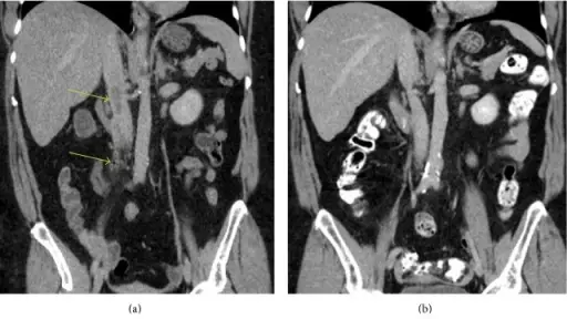 Thrombophlebitis