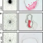 Thrombosis