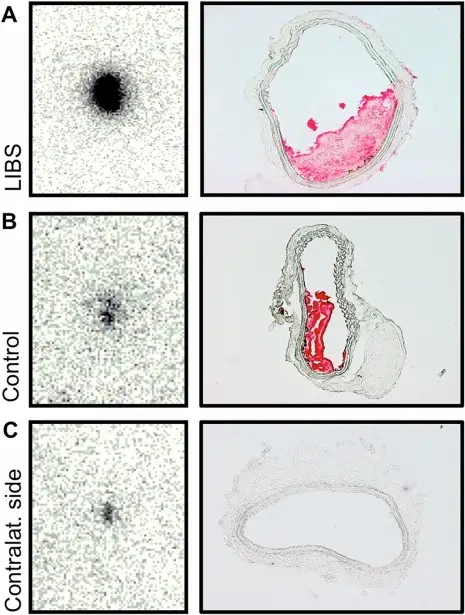 Thrombosis