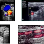 Thrombosis