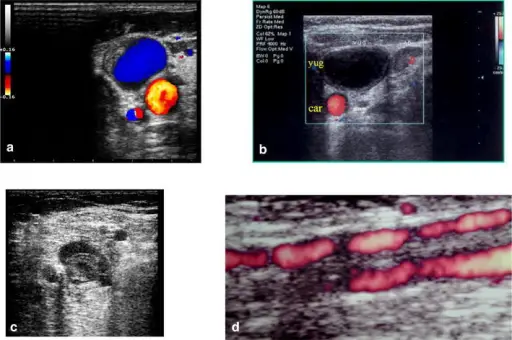 Thrombosis