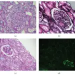 Thrombotic Microangiopathies Involving the Kidney