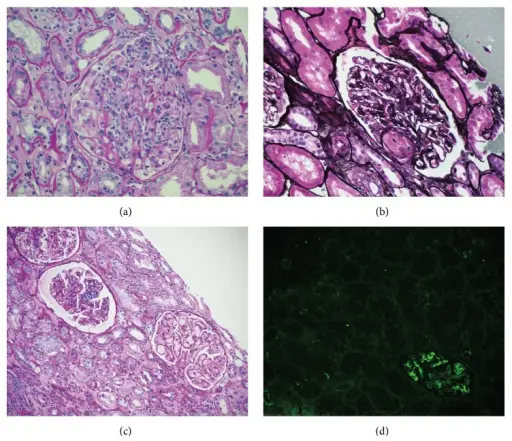 Thrombotic Microangiopathies Involving the Kidney