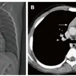 Thymic Aplasia