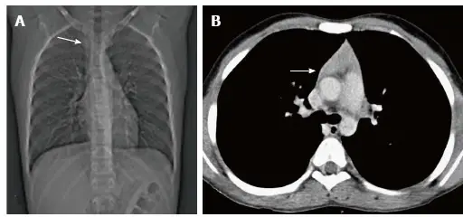 Thymic Aplasia