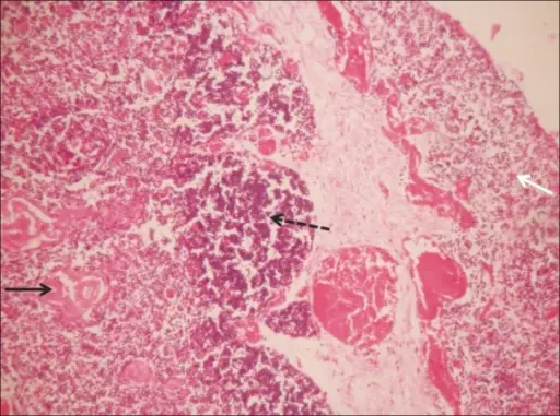 Thymic Cysts