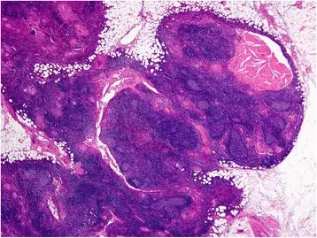 Thymic Hyperplasia