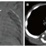 Thymic Hypoplasia