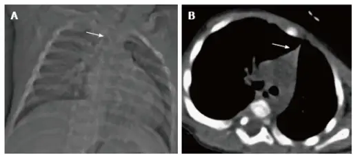 Thymic Hypoplasia