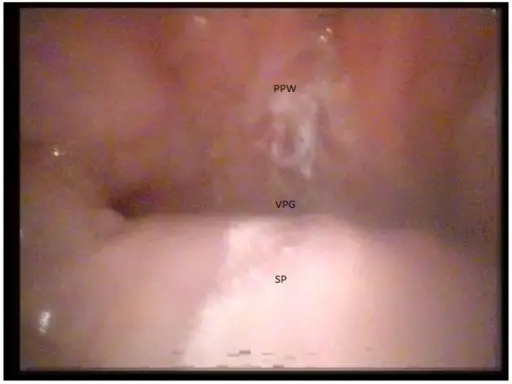 Thymic Hypoplasia