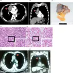 Thymoma