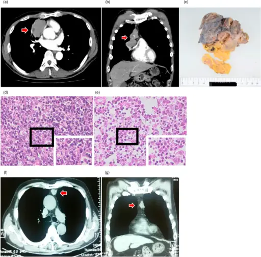 Thymoma