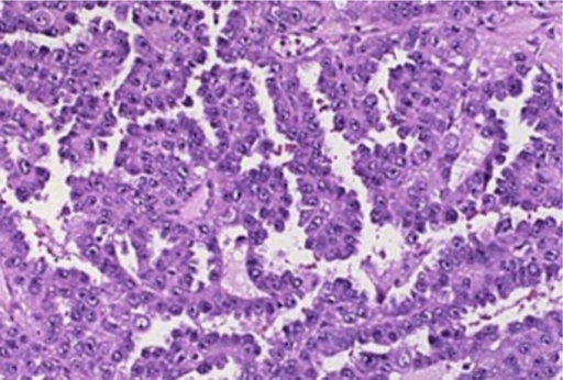 Thyroglossal Duct Cyst